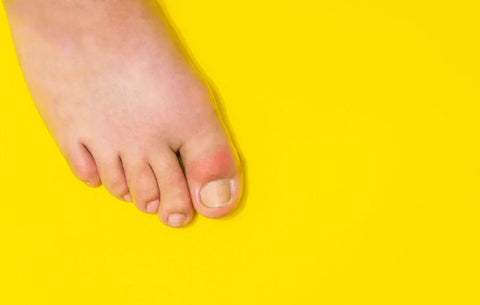 Hammartå: När tårna böjer sig av felbelastning – så förebygger du det