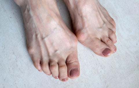 Så påverkar en sned stortå hela din kropp – och vad du kan göra åt det