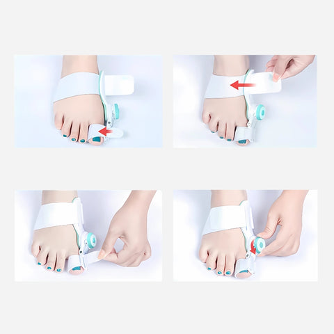 ErgiloHallux - Säädettävä varpaankorjaaja